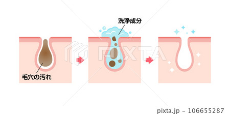 毛穴断面図イラスト / 角栓・皮脂汚れの詰まった毛穴をクレンジングできれいにする様子 毛穴断面図イラスト / 角栓・皮脂汚れの詰まった毛穴をクレンジングできれいにする様子 106655287