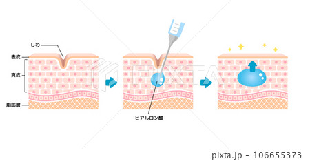 ヒアルロン酸注入によるしわ取り / 仕組み図解イラスト ヒアルロン酸注入によるしわ取り / 仕組み図解イラスト 106655373