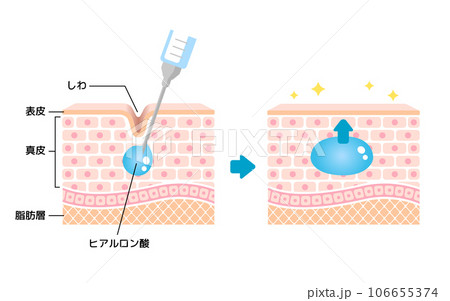ヒアルロン酸注入によるしわ取り /  仕組み図解イラスト 106655374