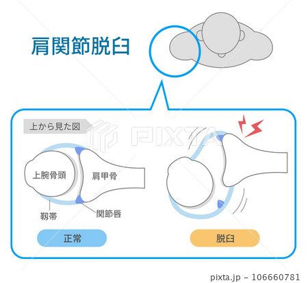 上から見た肩関節脱臼の仕組みと原因 106660781