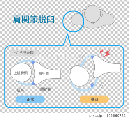 上から見た肩関節脱臼の仕組みと原因 106660781