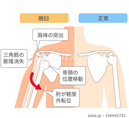 肩関節脱臼の仕組み比較図 肩関節脱臼の仕組み比較図 106660782