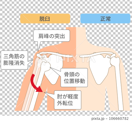 肩関節脱臼の仕組み比較図 肩関節脱臼の仕組み比較図 106660782