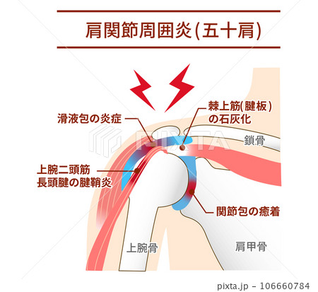 肩関節周囲炎,五十肩の仕組みとその原因のイラスト素材 [106660784] - PIXTA
