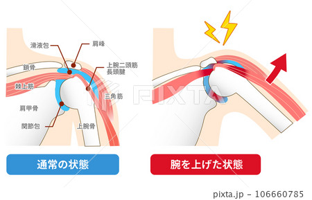 インピンジメント症候群。腕を上げた時に痛みを感じる原因と仕組みのイラスト素材 [106660785] - PIXTA