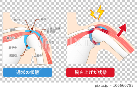 Impingement syndrome. Causes and mechanisms of pain when raising the arm Impingement syndrome. Causes and mechanisms of pain when raising the arm 106660785
