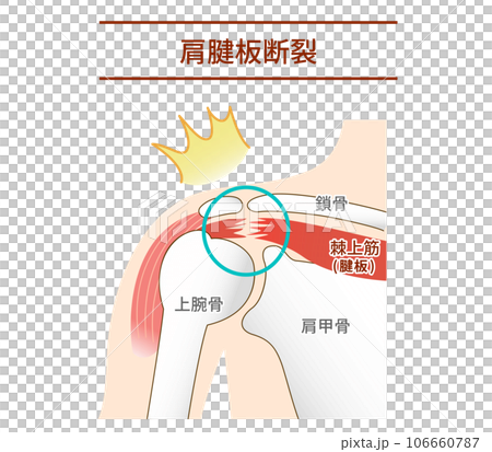 肩腱板断裂が起こる仕組みと原因 106660787