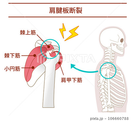 横から見た腱板断裂が起こる仕組みと原因 106660788