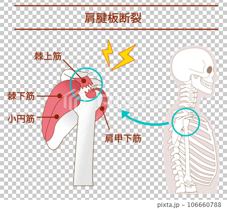 横から見た腱板断裂が起こる仕組みと原因 106660788