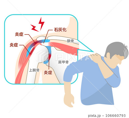 肩関節周囲炎,五十肩の痛みに苦しむ男性 106660793