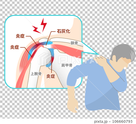 肩関節周囲炎,五十肩の痛みに苦しむ男性 106660793