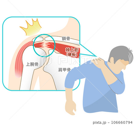 肩腱板断裂の痛みに苦しむ男性 106660794