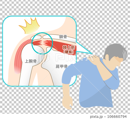 肩腱板断裂の痛みに苦しむ男性 106660794