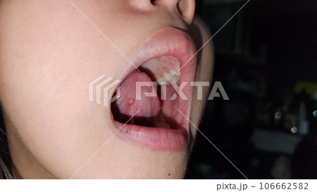 子供の下にできた小唾液腺の貯留嚢胞 子供の下にできた小唾液腺の貯留嚢胞 106662582