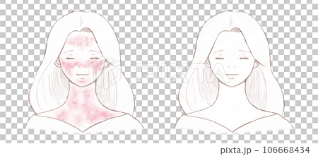 一名患有紅臉皮膚病的婦女和一名已完全治癒的婦女 背景上的透明線條畫 106668434