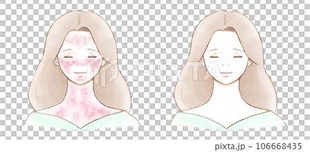 患有導致發紅的皮膚病的女性和完全康復的女性 106668435