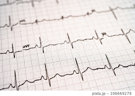 Electrocardiogram ECG, heart wave, heart attack, cardiogram report. 106669278