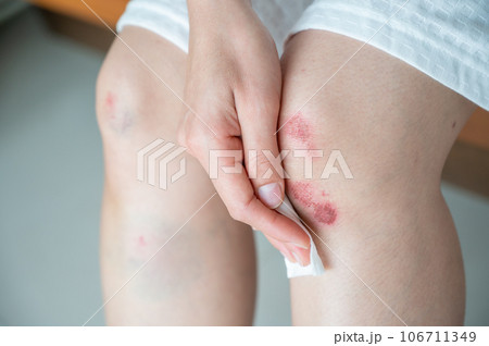Cropped shot of woman using tissue paper to clean her wound after Injured occur from falling or impact floor. Bruises happen when small blood vessels in the skin are damaged. 106711349