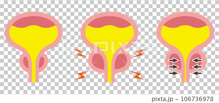 Illustration of normal prostate and prostatic hypertrophy Illustration of normal prostate and prostatic hypertrophy 106736978