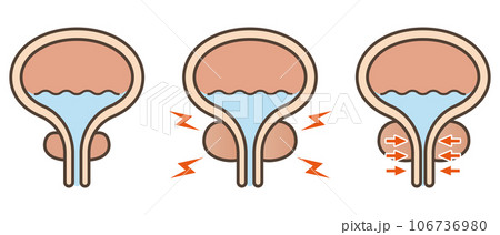 正常な前立腺と前立腺肥大のイラスト 正常な前立腺と前立腺肥大のイラスト 106736980