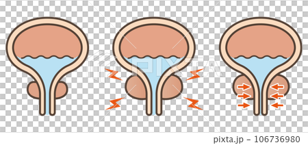 正常な前立腺と前立腺肥大のイラスト 正常な前立腺と前立腺肥大のイラスト 106736980
