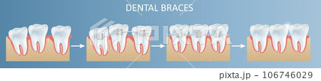 Dental teeth braces installation steps vector poster Dental teeth braces installation steps vector poster 106746029