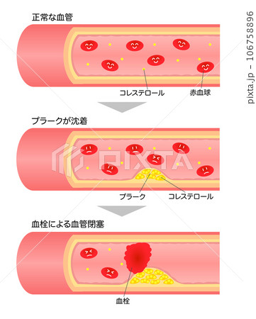 進行する動脈硬化の断面図の説明イラスト(顔付き赤血球) 進行する動脈硬化の断面図の説明イラスト(顔付き赤血球) 106758896
