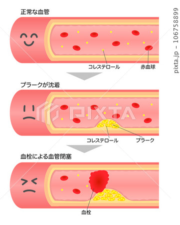 進行する動脈硬化の顔付き血管断面図のイラスト 106758899
