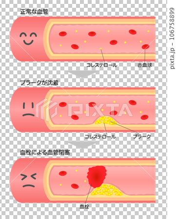 Illustration of a cross-sectional diagram of a blood vessel with a face showing progressing arteriosclerosis 106758899