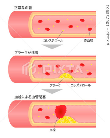 進行する動脈硬化の断面図の比較説明イラスト 106758901