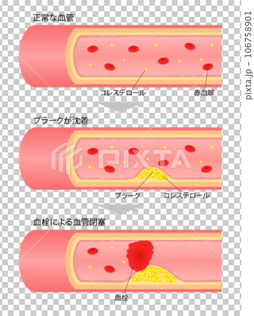 進行する動脈硬化の断面図の比較説明イラスト 106758901