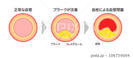 進行する動脈硬化の縦断面図の説明イラスト（横長） 106759004