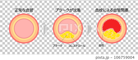 進行する動脈硬化の縦断面図の説明イラスト（横長） 106759004