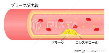 動脈硬化によりプラークで狭窄した血管の横断面図のイラスト 動脈硬化によりプラークで狭窄した血管の横断面図のイラスト 106759008