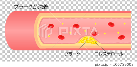 動脈粥樣硬化導致斑塊變窄的血管橫截面圖插圖 動脈粥樣硬化導致斑塊變窄的血管橫截面圖插圖 106759008