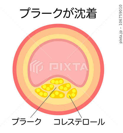 動脈硬化によりプラークで狭窄した血管の縦断面図のイラスト 106759010