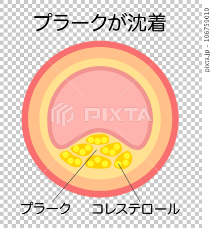 動脈硬化によりプラークで狭窄した血管の縦断面図のイラスト 106759010