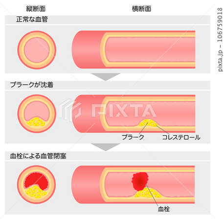 進行する動脈硬化の縦横断面図の比較説明イラスト 進行する動脈硬化の縦横断面図の比較説明イラスト 106759018