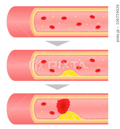 進行する動脈硬化の断面図のイラスト 106759026
