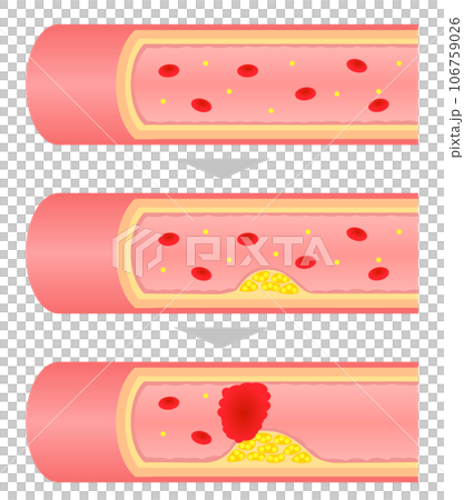 進行する動脈硬化の断面図のイラスト 106759026