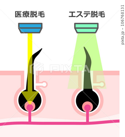 脱毛で使われるエステ脱毛と医療用脱毛の違いを説明するイラスト 脱毛で使われるエステ脱毛と医療用脱毛の違いを説明するイラスト 106768131