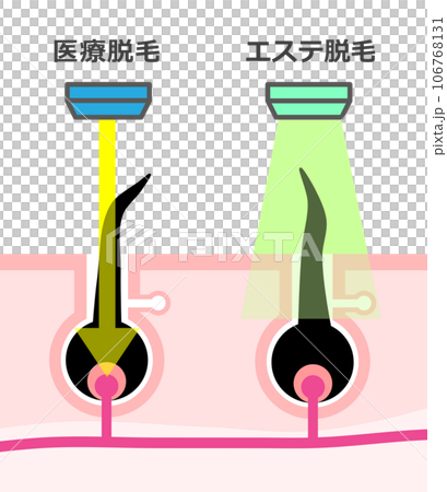 Illustration explaining the difference between aesthetic hair removal and medical hair removal used for hair removal Illustration explaining the difference between aesthetic hair removal and medical hair removal used for hair removal 106768131