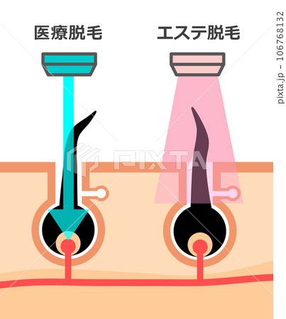 脱毛で使われるエステ脱毛と医療用脱毛の違いを説明するイラスト 106768132