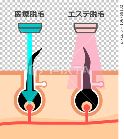 脱毛で使われるエステ脱毛と医療用脱毛の違いを説明するイラスト 106768132