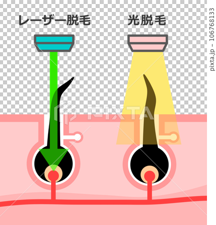 Illustration explaining the difference between aesthetic hair removal and medical hair removal used for hair removal 106768133