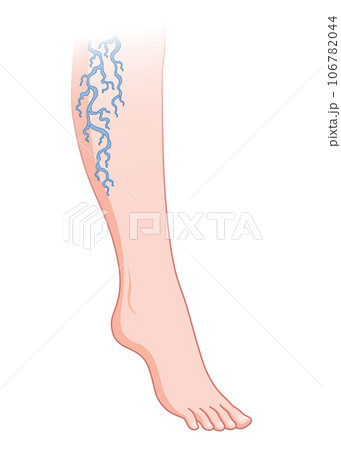 Varicose veins. Blue blood vessel visible through the skin, abnormally swollen leg. Vascular disease diagnostic and treatment. Venous insufficiency medical disease 106782044