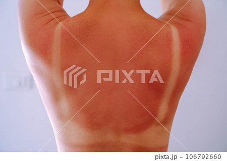 Back view of young woman with light traces of swimsuit on sunburnt naked back raise hands on blue background. UV rays. Back view of young woman with light traces of swimsuit on sunburnt naked back raise hands on blue background. UV rays. 106792660