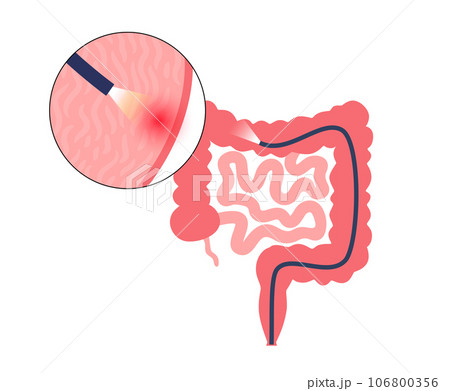 Colonoscopy medical procedure Colonoscopy medical procedure 106800356