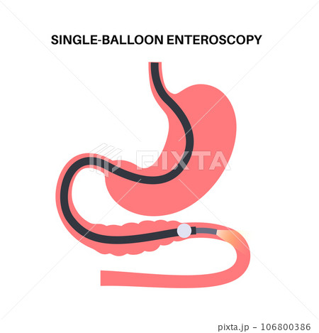Single balloon enteroscopy 106800386
