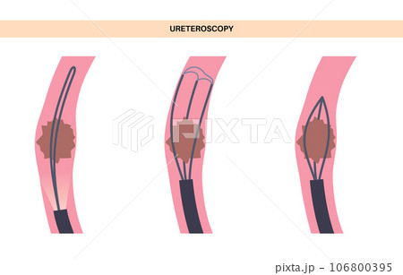 Ureteroscopy medical poster 106800395